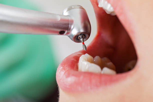 Best Emergency Wisdom Teeth Removal in Sorrento, LA